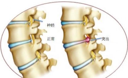 腰椎间盘突出压迫神经腰腿疼怎么治疗效果好？