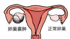 湖北中医药大学妇科专家武汉名老中医姜瑞雪教授：卵巢囊肿不孕吃什么中