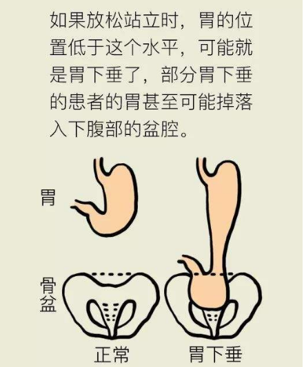 中医治疗胃下垂