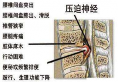 武汉骨科中医院孔政：腰椎间盘突出压迫神经腿麻腿痛针灸怎么治疗？