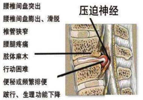 腰椎间盘突出压迫神经腿麻腿痛针灸怎么治疗？