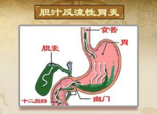 胆汁返流性胃炎胃痛胃胀呕吐怎么调理？