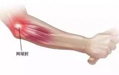 手肘疼痛不能握物抬不起来用力就疼痛中医针灸治疗怎么样？