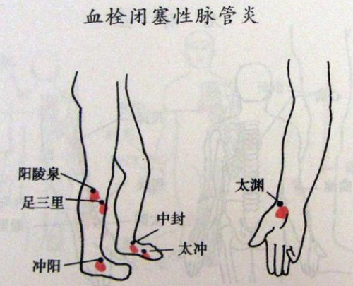 脉管炎中医诊断图片