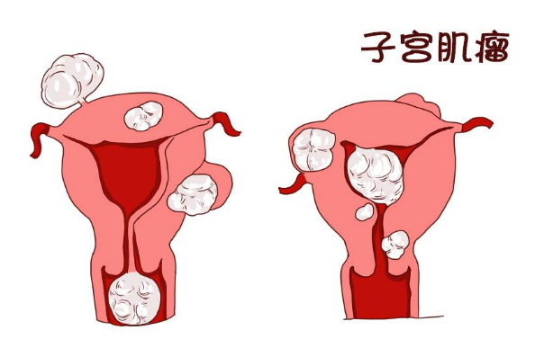 中医治疗子宫肌瘤