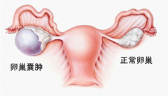 武汉妇科中医专家姜瑞雪教授：卵巢囊肿5.7×4.8×3.3cm吃什么中药能调理好？