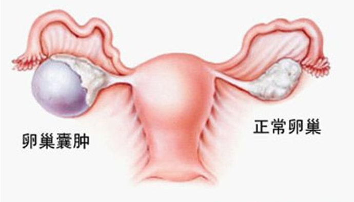 卵巢囊肿5.7×4.8×3.3cm吃什么中药能调理好？