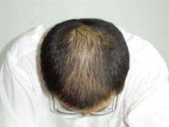 发际线后移秃头脱发怎么治疗好？中医治疗22岁的年轻脱发患者医案