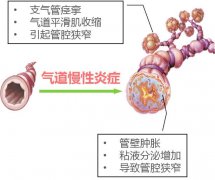 慢性支气管哮喘反复发作吃什么药才能好？向贤德中药汤剂加膏方治疗