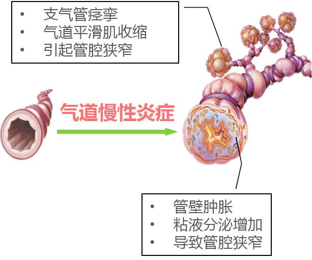 慢性支气管哮喘
