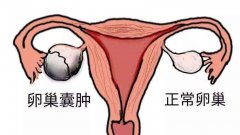 中医姜瑞雪：经行腹痛或者行经量多可能不仅仅是痛经！警惕卵巢囊肿