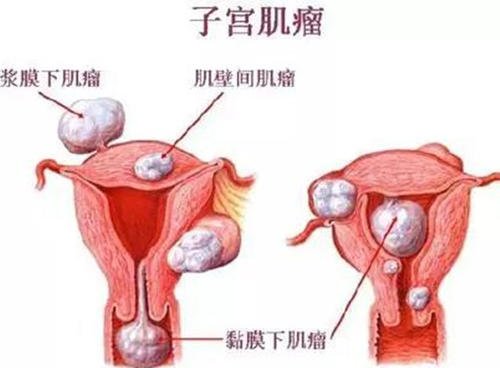 子宫肌瘤腰腹疼痛经期加重周身乏力吃什么中药能治好？