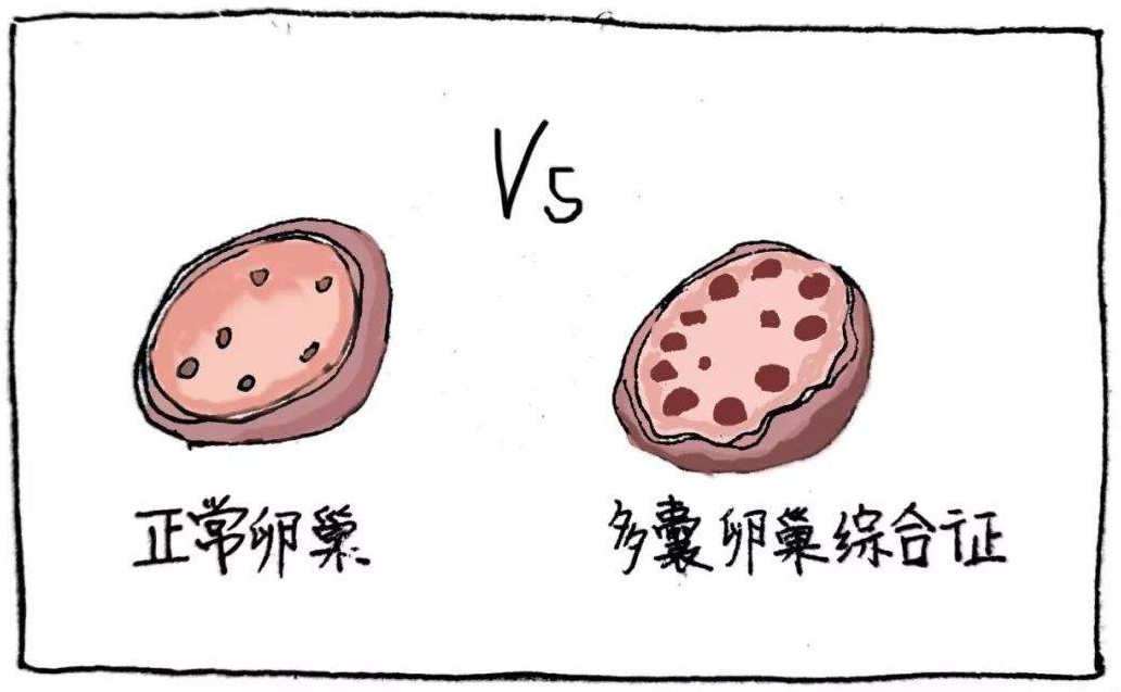 多囊卵巢综合征
