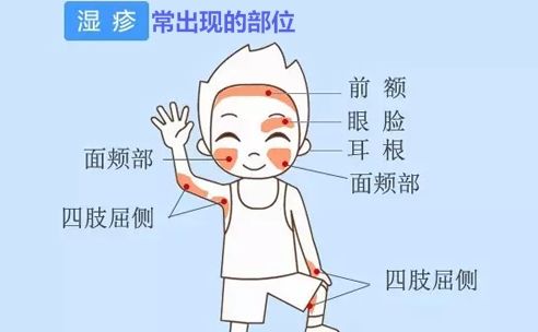 小孩湿疹颈部起红色皮疹瘙痒脱屑吃什么中药能治好？