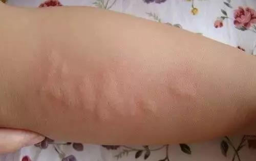 小孩得荨麻疹起红皮疹瘙痒遇热加重中医怎么治疗效果好？