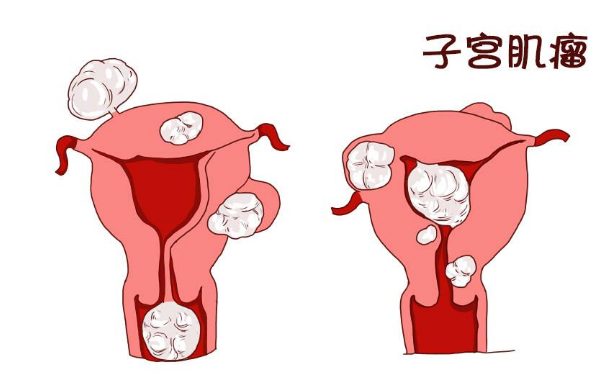 中医治疗子宫肌瘤
