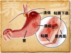 名老中医张林茂教授：胃溃疡左上腹部疼痛反复发作担心变为癌症吃什么中