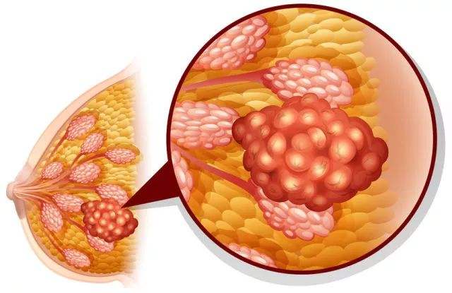 乳腺增生的照片图片