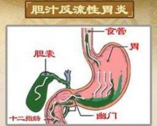 胆汁返流性胃炎晚上胃痛反复发作怎么治疗效果比较好？老中医张林茂妙开