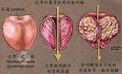 前列腺肥大12年排尿困难夜尿多吃什么药能治好？徐长化教授辨证论治有好