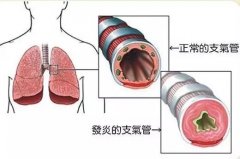 支气管炎咳嗽痰多气喘6年余到底应该怎么治？中医有哪些好的治疗方法？