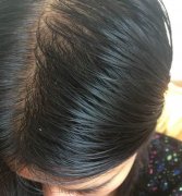 脂溢性脱发头皮油腻、脱屑瘙痒，头发越来越稀疏中医怎么治疗比较好？