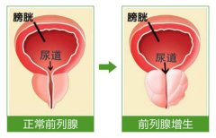 治疗前列腺增生10年尿频急小便浑浊起夜9次中药配方