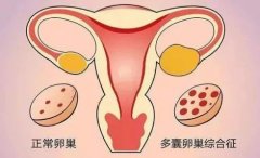 武汉知名妇科老中医姜瑞雪：多囊卵巢综合征月经不调、婚后两年不孕，中