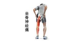 坐骨神经痛频繁发作哪种治疗方法比较有效？