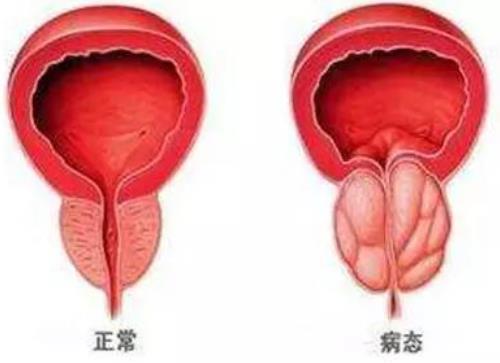 前列腺肥大症状图片
