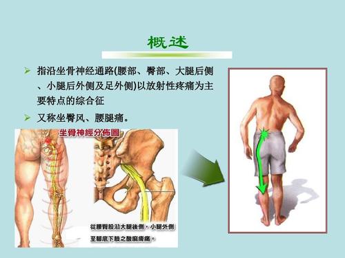 坐骨神经痛怎么治疗