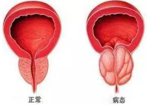 前列腺增生伴膀胱结石排尿困难夜尿8次咋办？