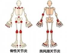 风湿诊疗专家宋跃进教授：临床上如何确诊类风湿性关节炎？有哪些症状？