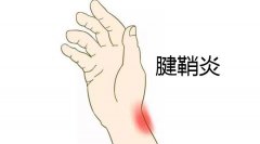 右手腱鞘炎疼痛肿胀灼热时有麻木影响正常活动怎么办？