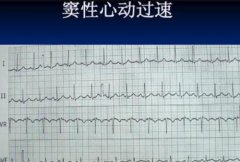 诚顺和中医馆王垚主任：窦性心动过速心慌全身出大汗胸憋闷右胁胀吃什么