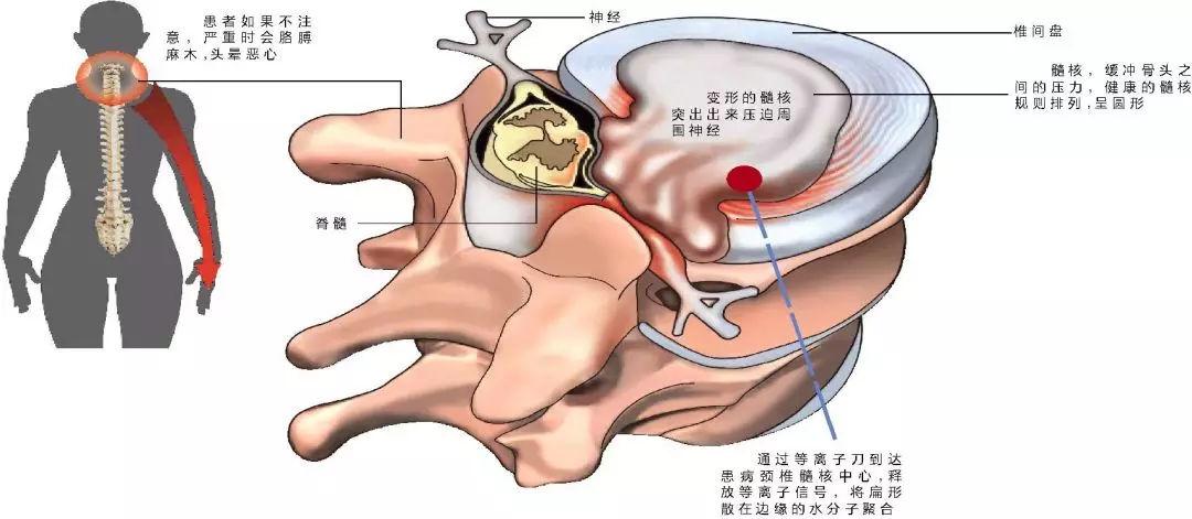 中医穴位按摩法能有效缓解颈椎痛吗？