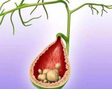 武汉有名的中医院脾胃病科张压西：体检查出胆结石吃什么中药可以化掉结