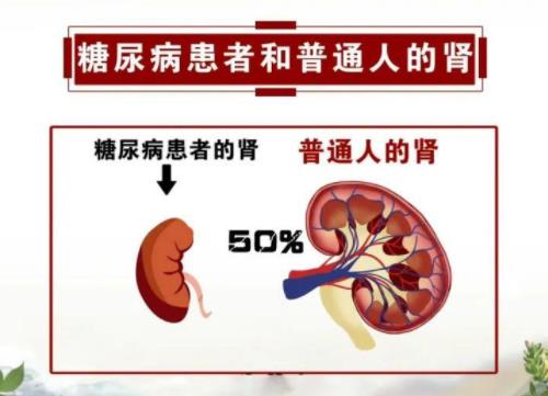 糖尿病肾病蛋白尿尿蛋白3+下肢水肿身困乏力汗多喜欢喝水怎么治？