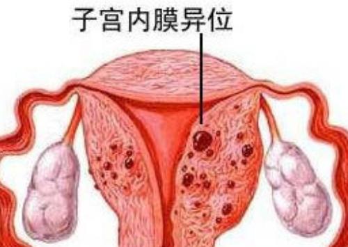 子宫内膜异位症痛经8年经前痛始第二天加重怎么治？