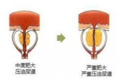 武汉比较好的中医男科专家王垚：前列腺增生尿频每天排尿13次精神疲惫乏