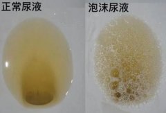 武汉名老中医王垚：慢性肾炎蛋白尿2+近2月小便混浊泡沫尿腰酸身困4年了怎