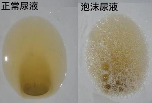 慢性肾炎蛋白尿2+近2月小便混浊泡沫尿腰酸身困4年了怎么治？