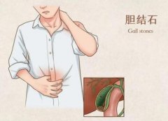 武汉胃肠专科老中医张压西教授：胆结石右胁下疼痛胃胀没胃口口苦失眠中