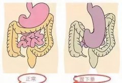 武汉肠胃科厉害的专家张压西教授：胃下垂饭后饱胀不适中药调理怎么样？