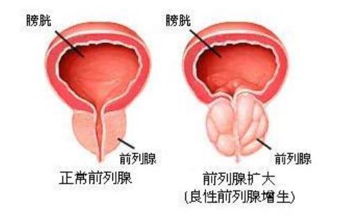 前列腺肥大伴有炎症尿频急每次量少尿不尽怎么治疗？