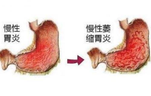 萎缩性胃炎之辨治思路