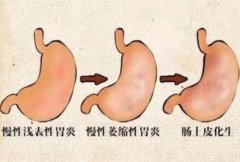武汉诚顺和中医内科王垚：重度慢性萎缩性胃炎伴重度肠化反复胃痛用什么