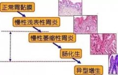 武汉中医胃肠内科门诊专家王垚主任：慢性萎缩性胃炎胃脘疼痛怕冷泛酸口