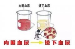 武汉厉害的老中医向贤德教授：反复血尿红细胞2+查不出原因中医有什么好