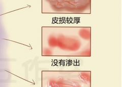 武汉皮肤病中医胡爱玲：慢性湿疹身上皮肤起红疹散发红斑中医可以治疗吗